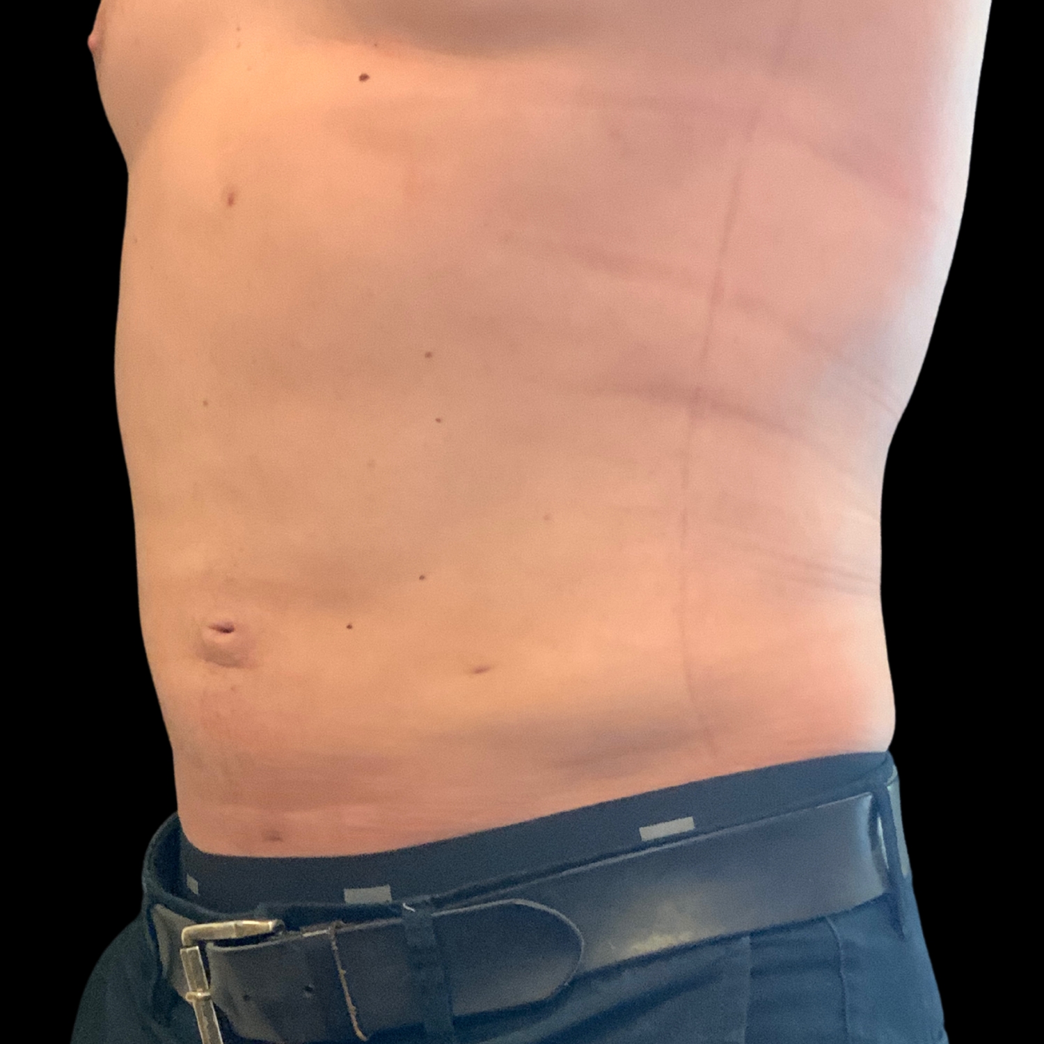 Liposuction Results Before and After