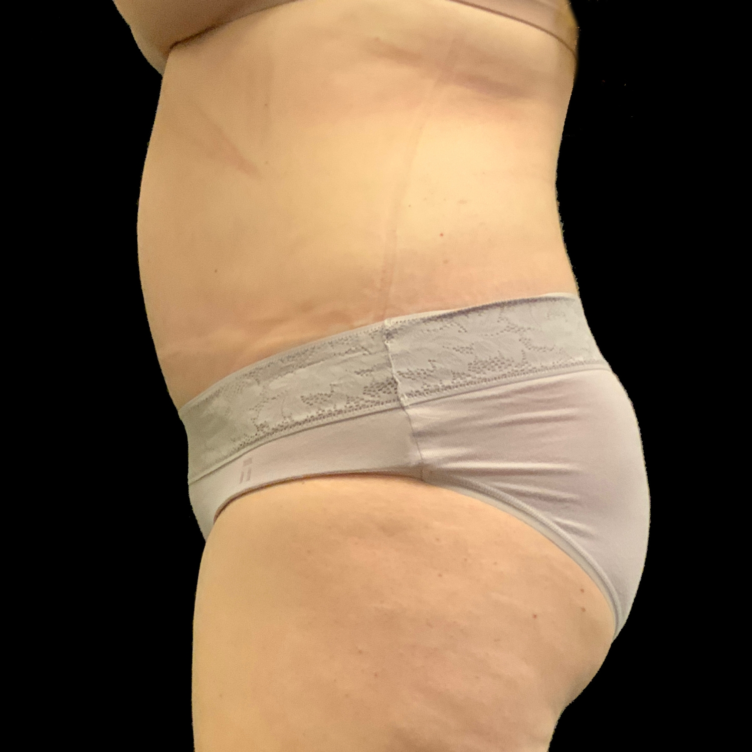 Dr. Parker Talks Tummy Tucks: Figuring Out a Treatment Plan for Top-Notch  Results