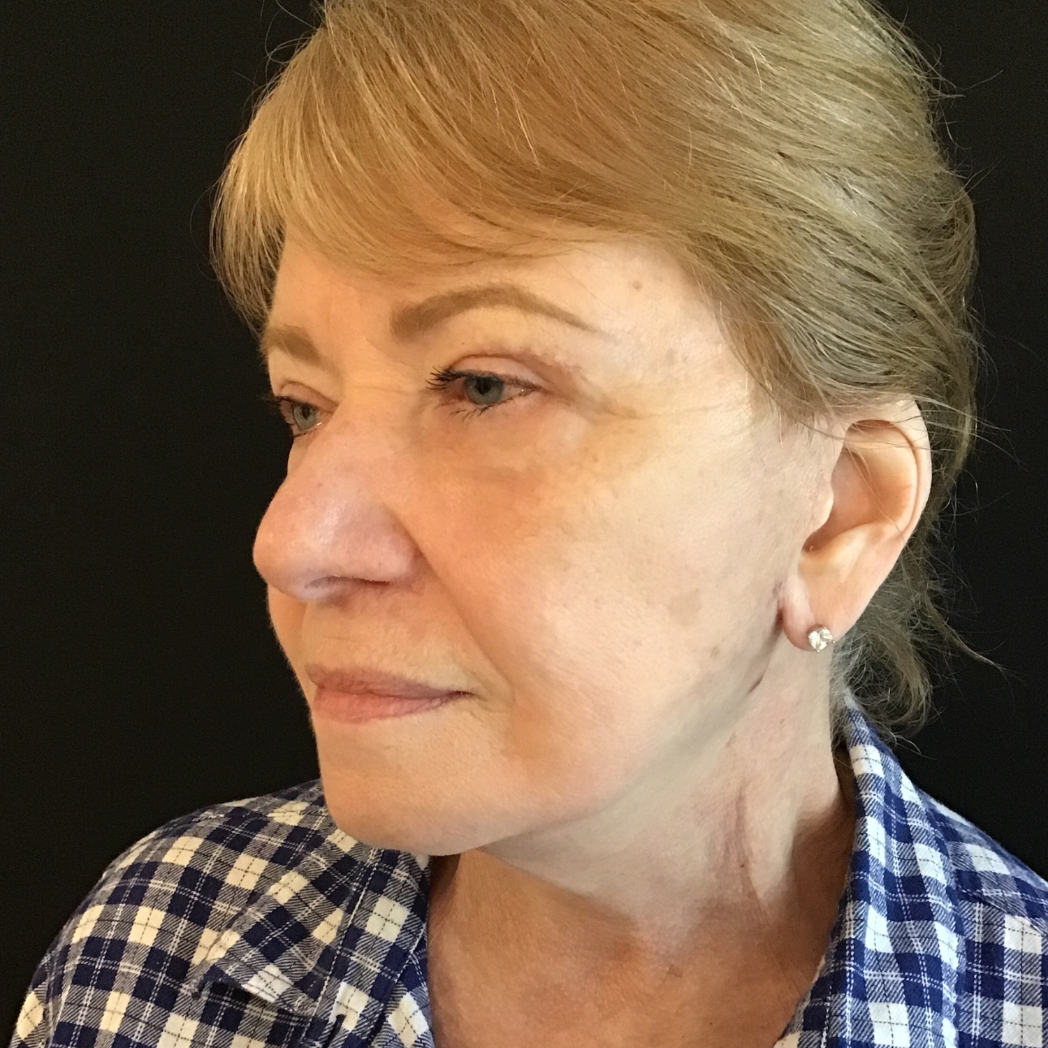 Facelift Results Before and After