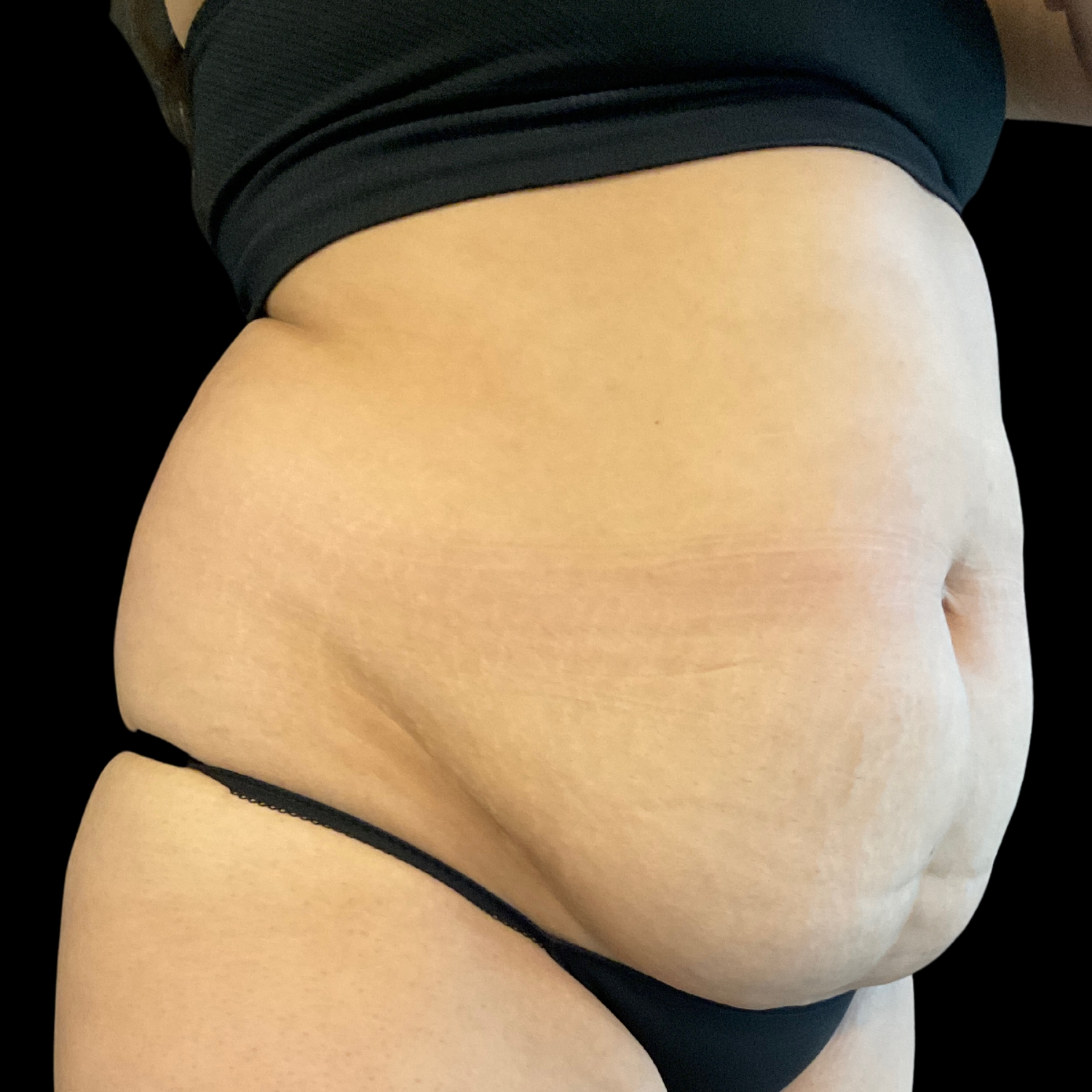Liposuction Results Before and After