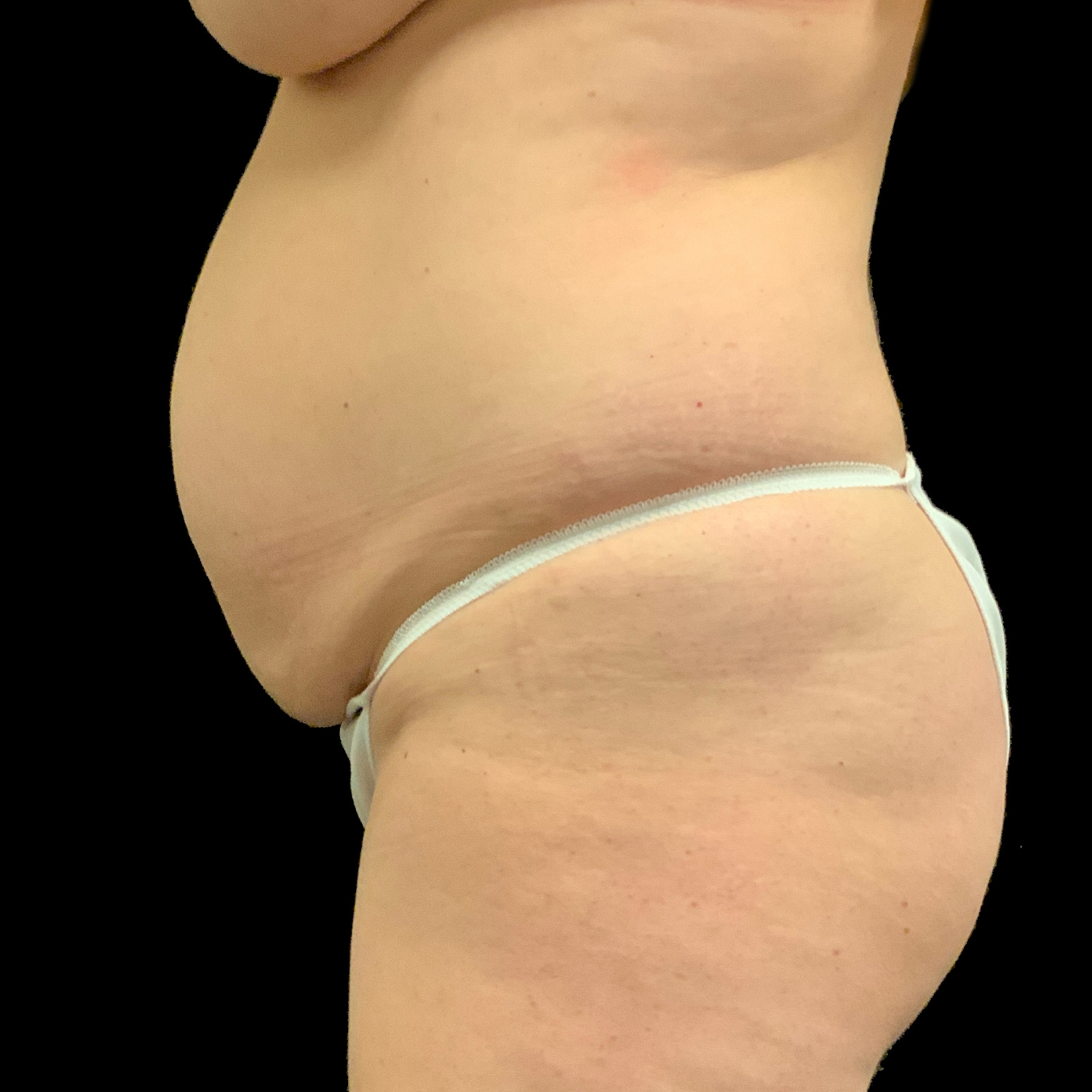 27 Woman After Tummy Tuck w Lipo 360