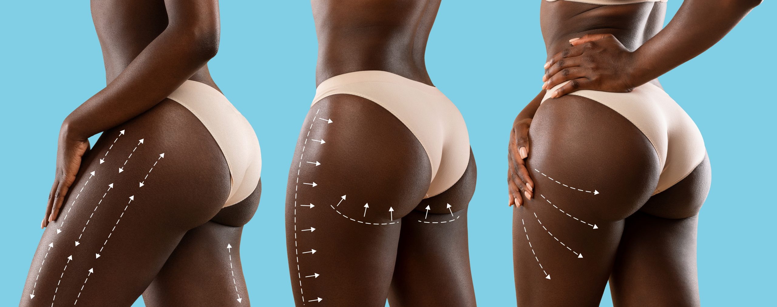 Post Surgical Compression Garments - Brazilian Butt Lift