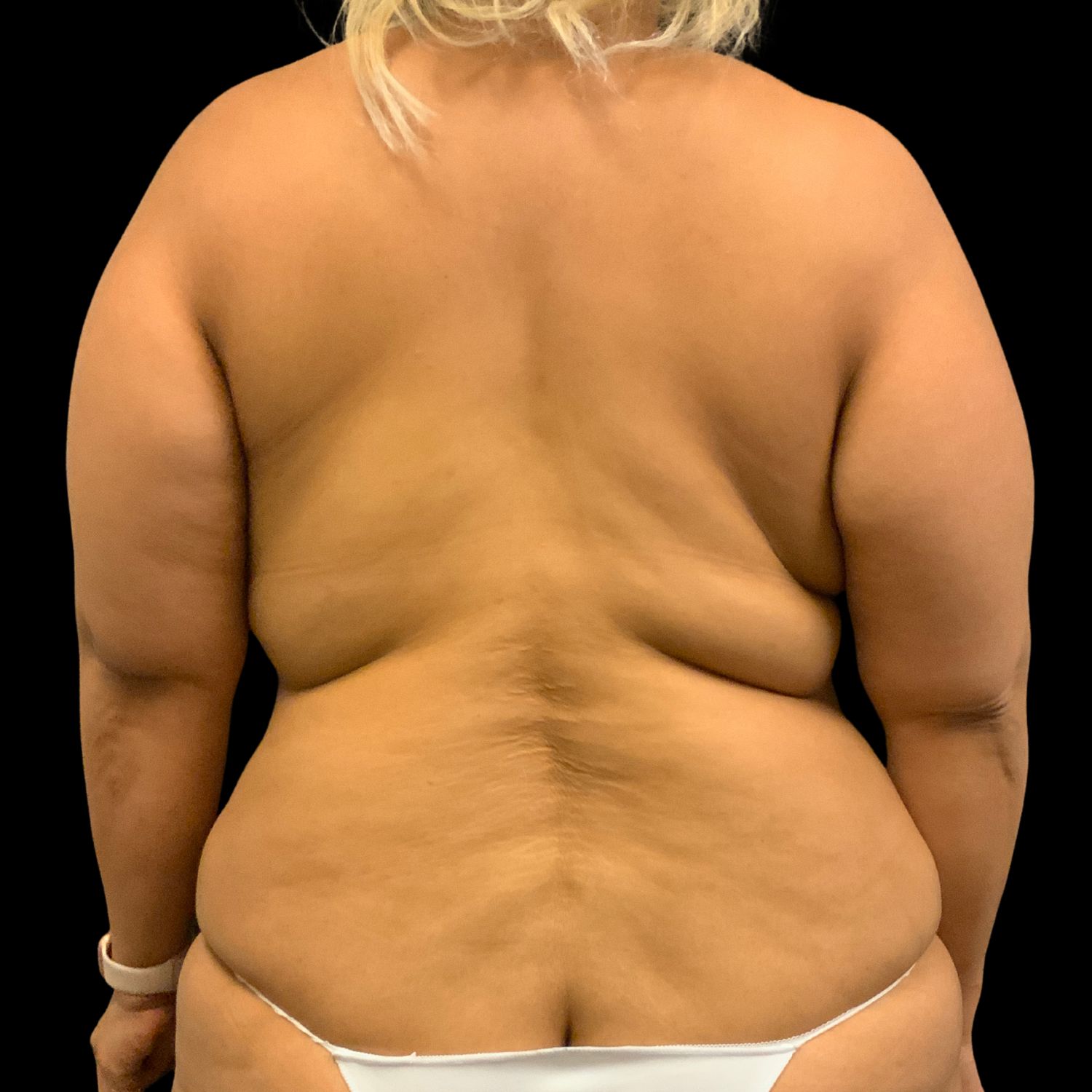 Back liposuction results