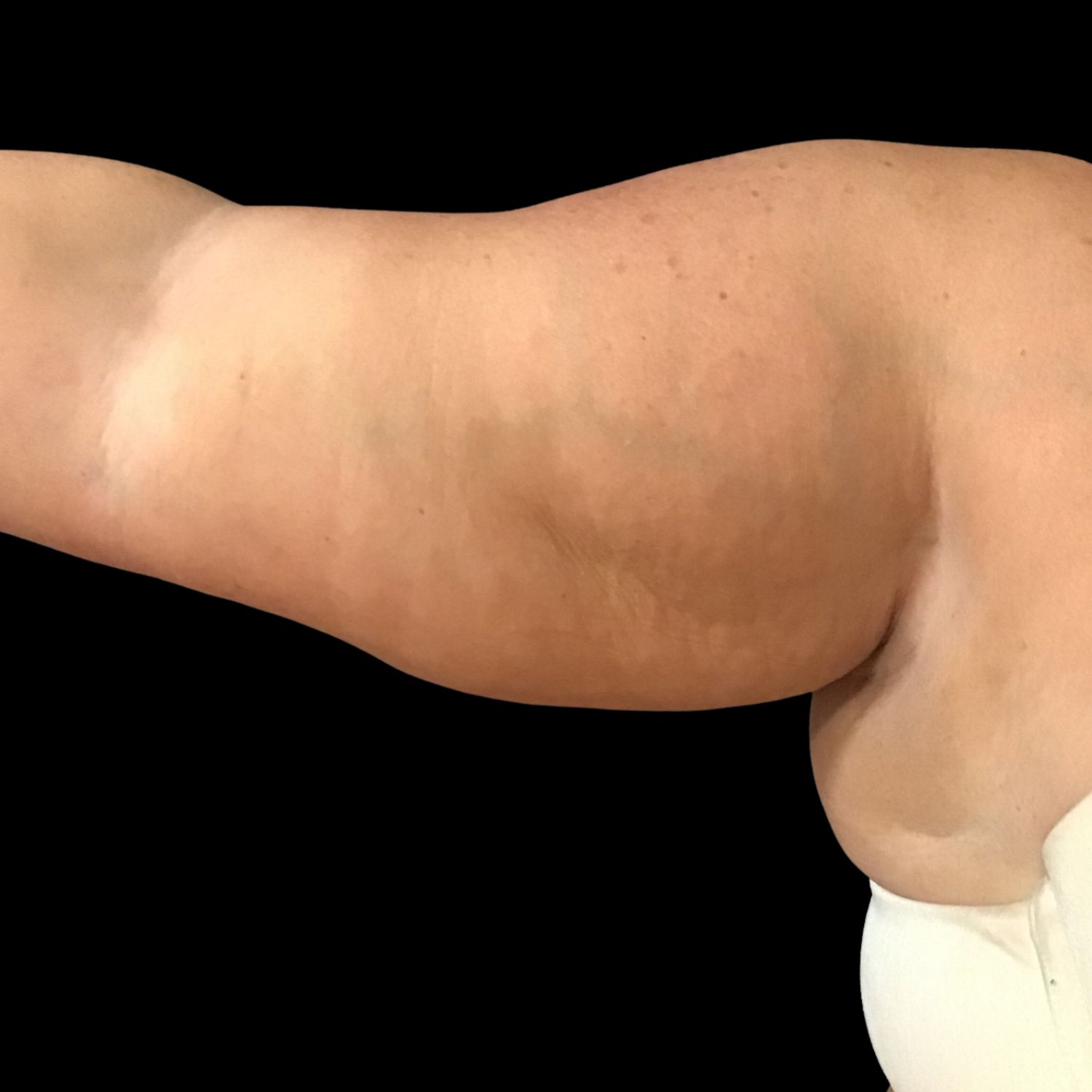 Arm liposuction results