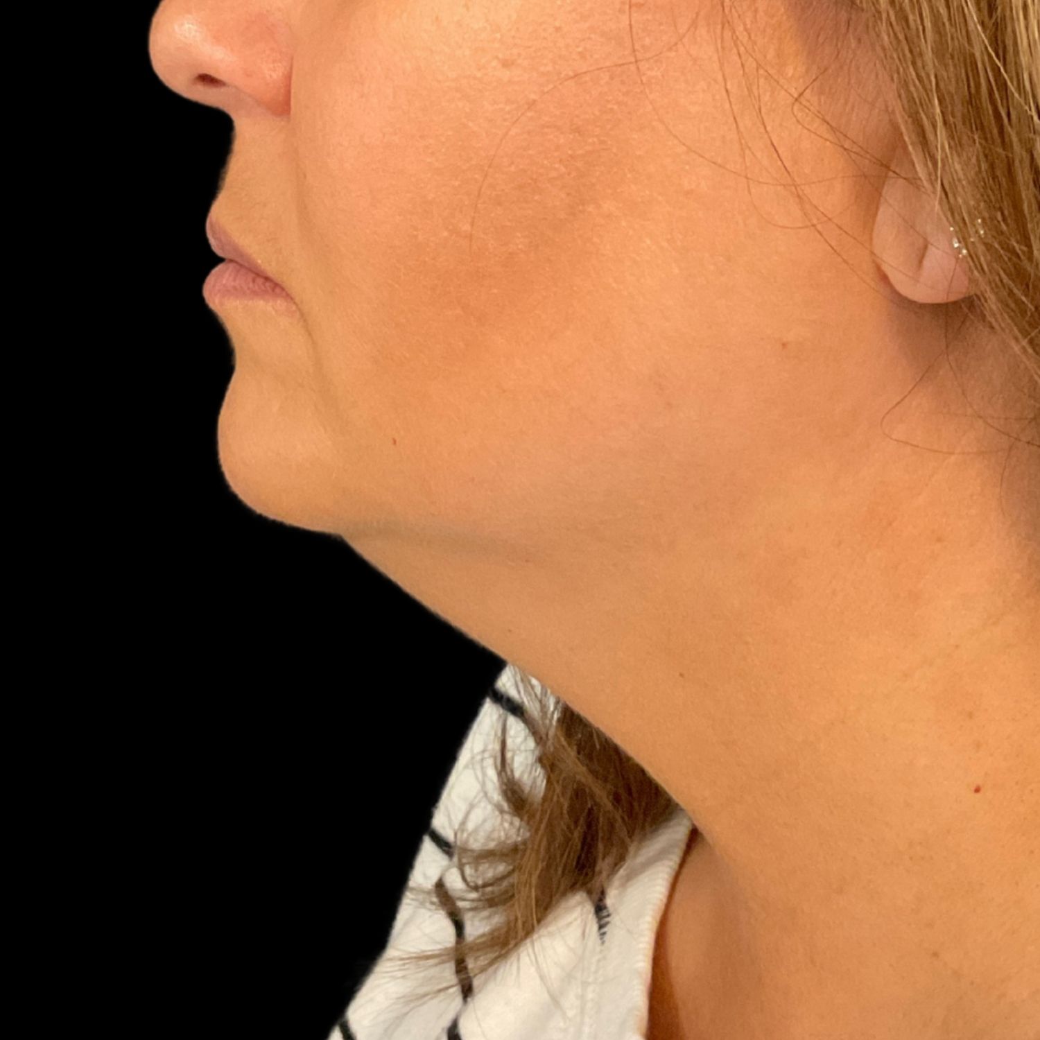 chin liposuction results